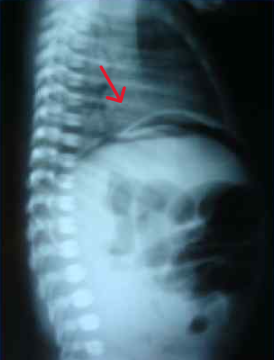 0101_Особенности ведения детей с кишечными стомами_рис. 4_2.png