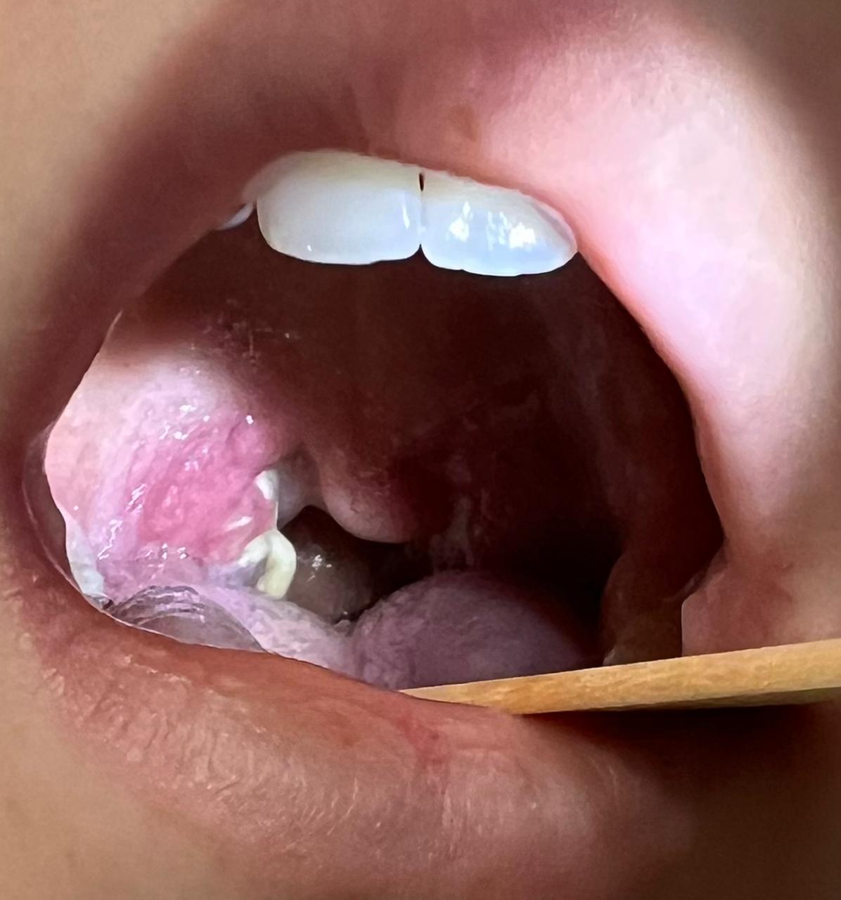 0106_Рис. 3. Налеты на миндалинах.jpg