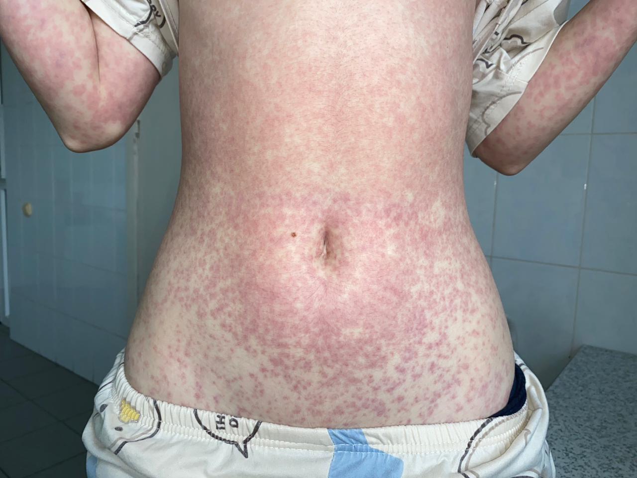 0106_Рис. 4. Амоксициллиновая сыпь на туловище.jpg