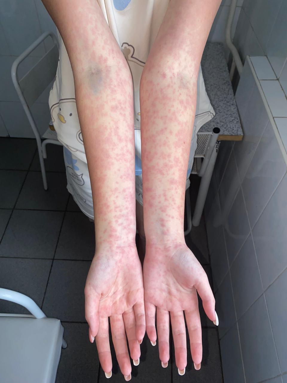 0106_Рис. 5. Амоксициллиновая сыпь на конечностях.jpg